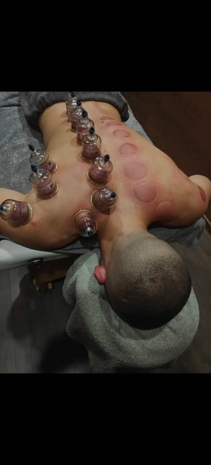 Вендузотерапия в PhysioPrime